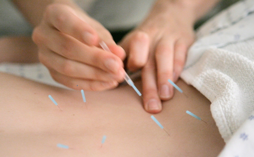 In this Monday, Sept. 24, 2007 file photo, Anah McMahon adjusts seirin acupuncture needles in the muscles around the spine of a patient at the Pacific College of Oriental Medicine in Chicago. (AP Photo/M. Spencer Green)
