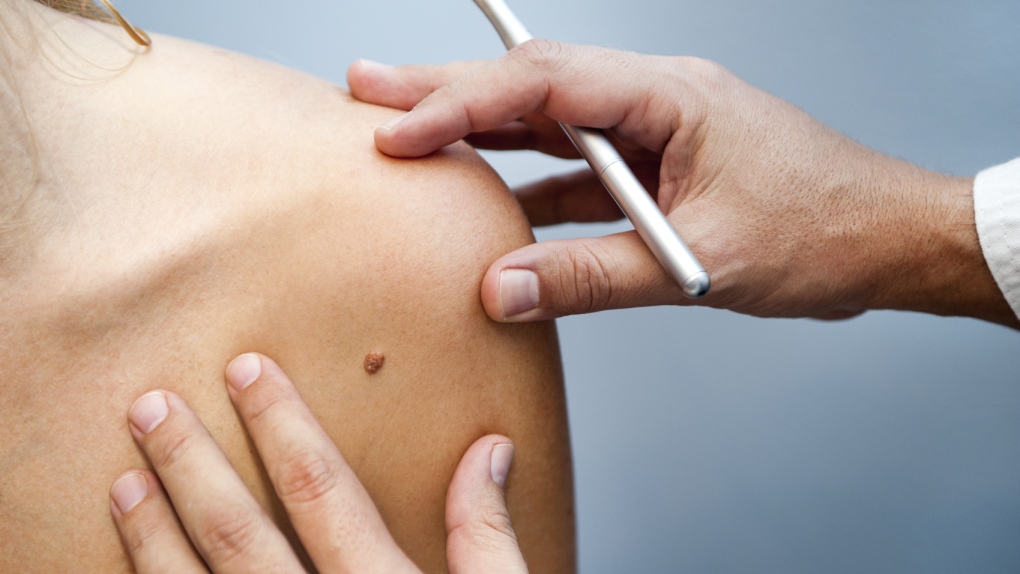 A doctor inspects a patient's mole for skin cancer in this file photo. (damiangretka / istock.com)