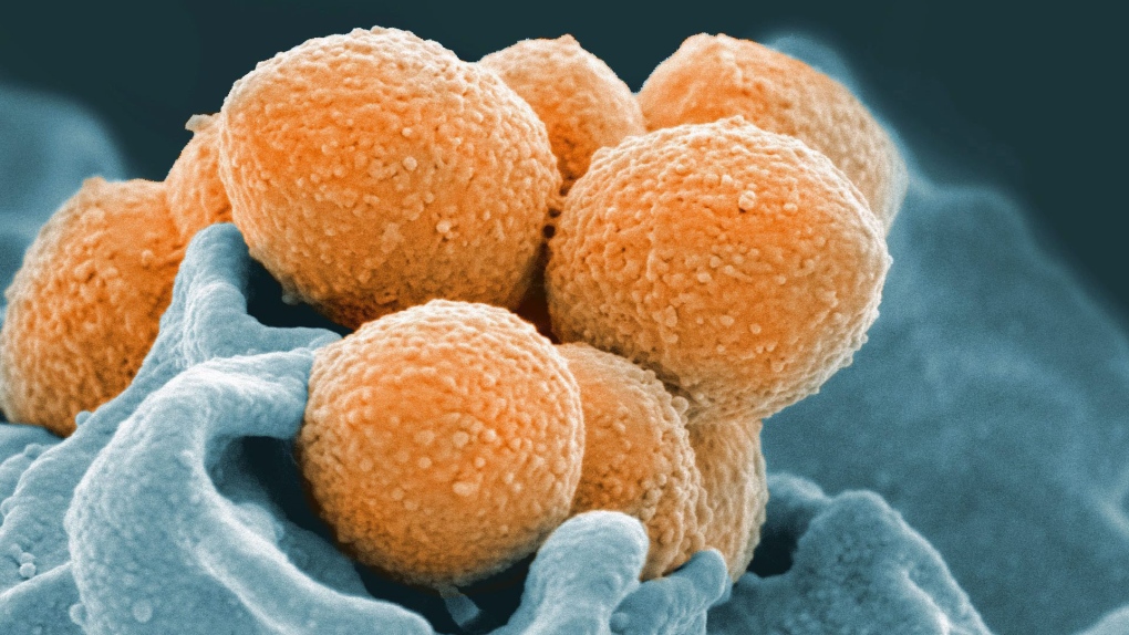 This handout image provided by the U.S. National Institute of Allergy and Infectious Diseases shows an electron microscope image of Group A Streptococcus (orange) during phagocytic interaction with a human neutrophil (blue). (National Institute of Allergy and Infectious Diseases via AP) 