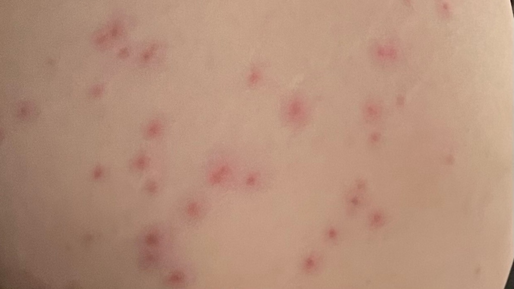 Whitby spa staph outbreak sees dozens file civil declare